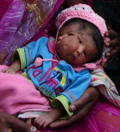 RNPS IMAGES OF THE YEAR 2008
A girl born with two faces rests ...